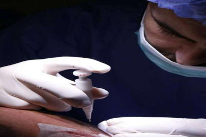 DHI Saç Ekimi Tekniği Nedir?