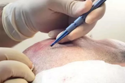 Safir Saç Ekiminin Avantajları Nelerdir?